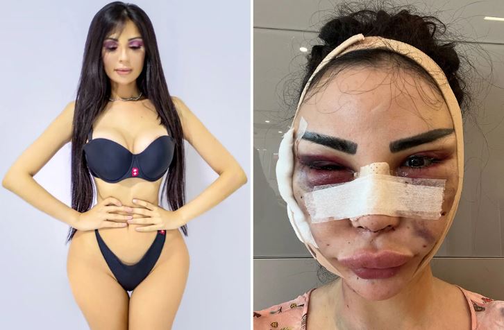  ಖ್ಯಾತ ನಟಿಯಂತಾಗಲು 12 ವರ್ಷದಲ್ಲಿ 40 ಬಾರಿ ಶಸ್ತ್ರಚಿಕಿತ್ಸೆಗೊಳಗಾದ ಯುವತಿ: ಕೊನೆಗೂ ಆಗಿದ್ದೇನು ಗೊತ್ತಾ?