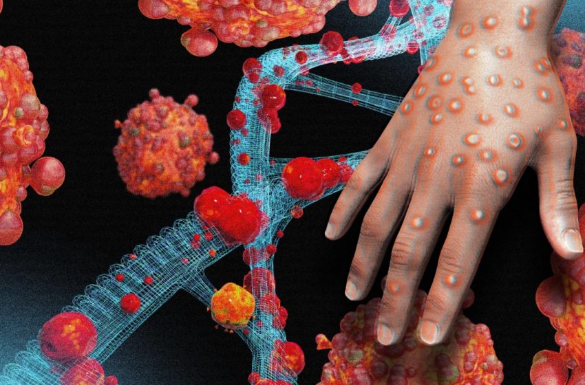  ಭಾರತಕ್ಕೆ ಎಂಟ್ರಿಕೊಟ್ಟ ಮಂಕಿಪಾಕ್ಸ್? ಆಸ್ಪತ್ರೆಗೆ ದಾಖಲಾದ ಯುವಕ